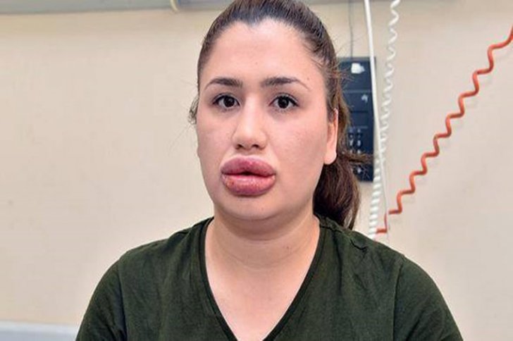 Azərbaycanda təhsil alan türk həkimin bədbəxt etdiyi qızın son halı hamını təəccübləndirdi -